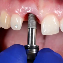 Dental Implants